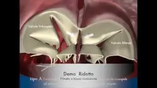 Difetti canale intraverticolare