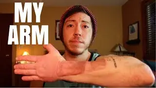 FTM Phalloplasty How I Feel About My Arm