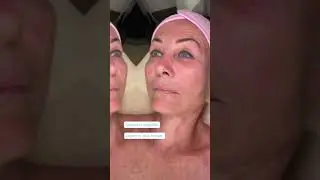 VAMP Facial ￼🫧🌟