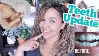 Candid Aligners Teeth Update BEFORE & AFTER