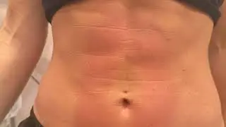Emsculpt Neo is a non-invasive body contouring treatment #emsculpt #sculpting 