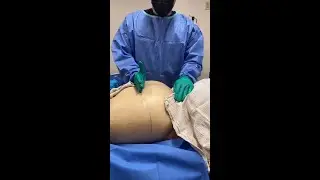 Lipedema Reduction Surgery on the Buttocks area