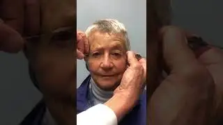 Ptosis Explained