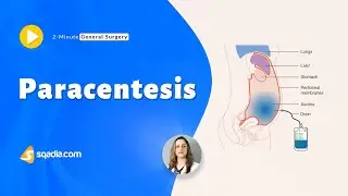 Paracentesis | General Surgery Video | Medical Education | V-Learning&trade; | sqadia.com