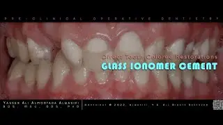 Glass Ionomer Cement