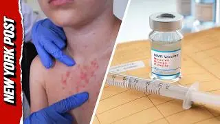 Measles Outbreak Takes Deadly Turn as Pennsylvania Reports First U.S. Deaths