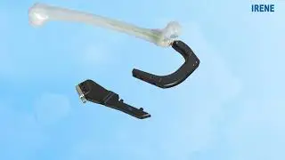 IRENE NAVIGATOR TFA Interlocking Nail System (TFNA)