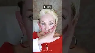 Skin Pinch Test Follow Up