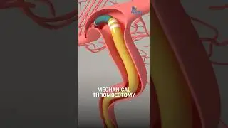 Mechanical Thrombectomy for Stroke | Dr Sudhir Kumar | Apollo Hospitals