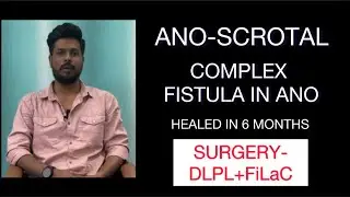 FISTULA UPTO THE SCROTUM, HEALED WITH DLPL/FiLaC SURGERY #fissuretreatment #fistulainano