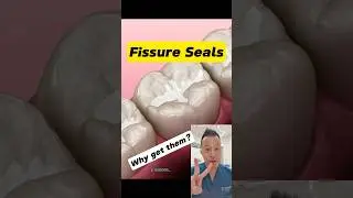 Seal Out Decay: The Benefits of Fissure Sealants #shorts #dentallan #dentist