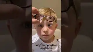 Accommodative esotropia
