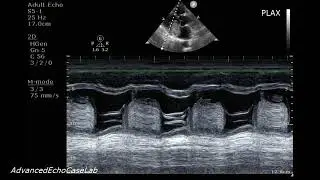 Left Atrial Myxoma: Echocardiographic Visualization from Standard Views.