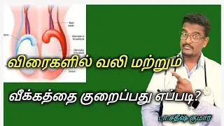 How to Cure Testicle (Orchitis)Infection in Tamil?|| Doctor Satheesh || Yes1TV Tamil