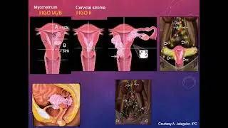 Imaging of the Endometrial and Cervical Carcinomas