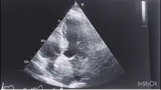 Interesting: learning echo  ? Any abnormality