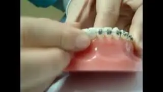 Kreashko Orthodontics - Home Emergency Braces Repair (Part 3)