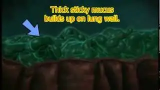 Defective CFTR: mucus build-up animation