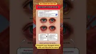 Conjunctivitis (Pink Eye): Viral, Bacterial, and Allergic &mdash; Causes, Symptoms and Treatment Explained