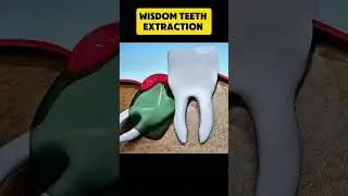 Wisdom Teeth Extraction