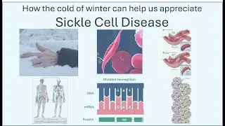 What might Sickle Cell Disease feel like?