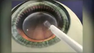 Implantable Contact Lens