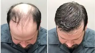 MXD20 CAPILAR 🧔