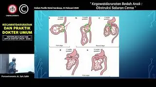 017 Kegawatdaruratan Bedah Anak Obstruksi Saluran Cerna Anak - Purnawirawanto, dr., SpA, SpBA