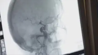 How to recognize when a person is having a stroke