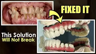 How to Make a Full-Mouth Implant That Stops Ti-Base from Failing
