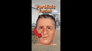 Qu&eacute; ejercicios hacer en la Par&aacute;lisis facial