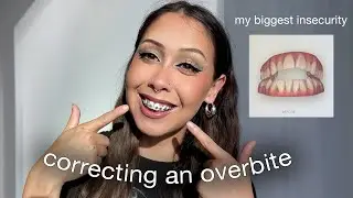 i got BRACES for the first time! | Open Bite Correction