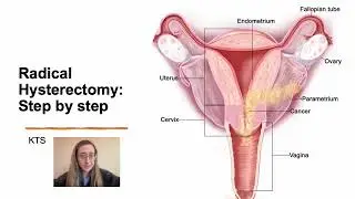 Radical Hysterectomy Step by Step