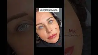 &Uuml;ST G&Ouml;Z KAPAĞI AMELİYATIUPPER EYELID SURGERY