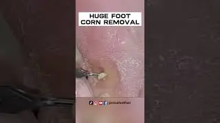 Удаление огромных мозолей на ногах