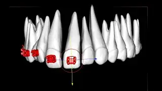 Placing orthodontic brackets on central incisors