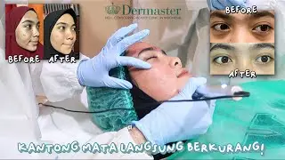 Pengalaman Treatment di DERMASTER Kantong Mata Hilang & BYE BRUNTUSAN👋🏻