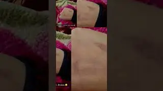 Red Hand Game Gone Wrong | Bruised | Injury | Painful