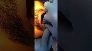 Dental Mono Implant Procedure