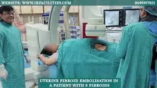 Uterine Fibroid Embolization for 8 Fibroids:Non-Surgical Treatment- Dr. Sandeep Sharma- IRFACILITIES