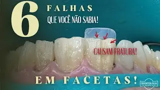 6 FALHAS EM FACETAS que v&atilde;o Causar FRATURAS E VOC&Ecirc; NEM SABIA!🤔