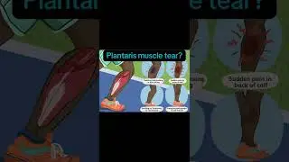 Plantaris and/or Medial Calf tear?