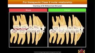 How I place the molar tubes?