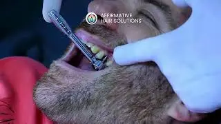Dental Implants Explained | Permanent Smile Solutions at Affirmative Smile