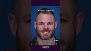 Lateral Jaw Reduction| Jaw Asymmetry| Vline| Plastic Surgery
