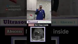 Liver Cyst vs Liver Abscess #radiologyeducation
