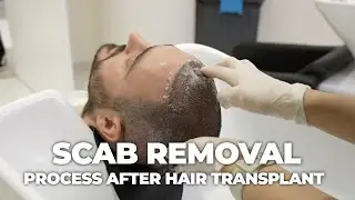 Scab Removal After Hair Transplant: Essential Techniques!