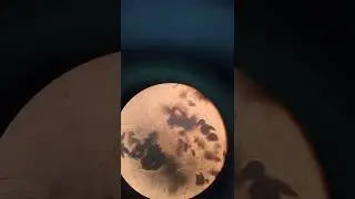 حبيبات النشا بصبغة اليود في البراز iodine stained starch granules in stool