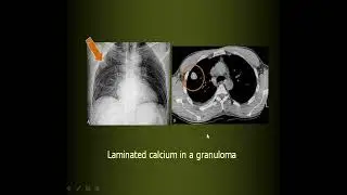 Focal lung lesions CS