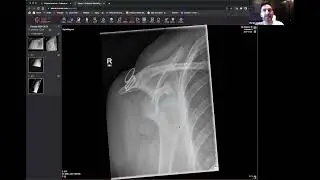 Don&rsquo;t Miss the Y View! A Practical Guide to Shoulder Dislocation on X-Ray